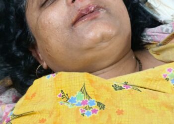 সম্পত্তি বিবাদের জের, শিলচরে কামড়ে নিজের দিদির নাক খুবলে নিলেন বিজেপি নেত্রী !