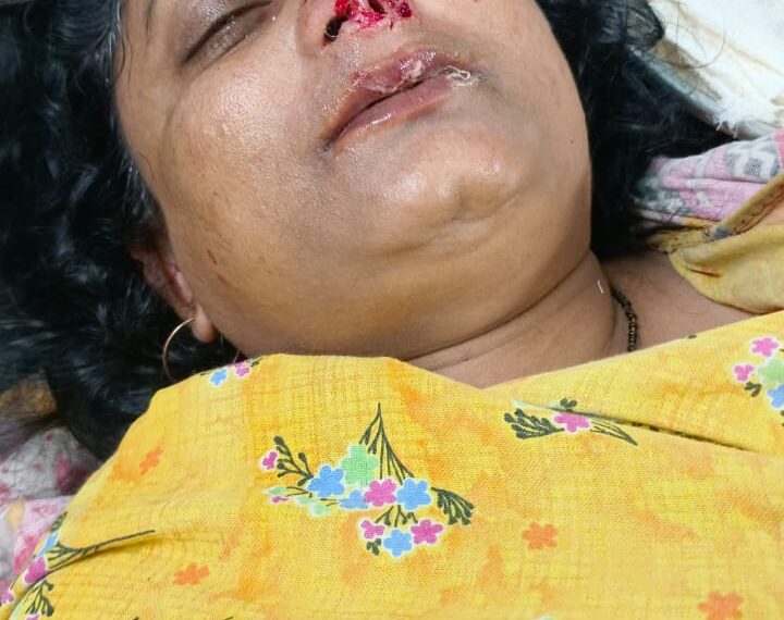 সম্পত্তি বিবাদের জের, শিলচরে কামড়ে নিজের দিদির নাক খুবলে নিলেন বিজেপি নেত্রী !